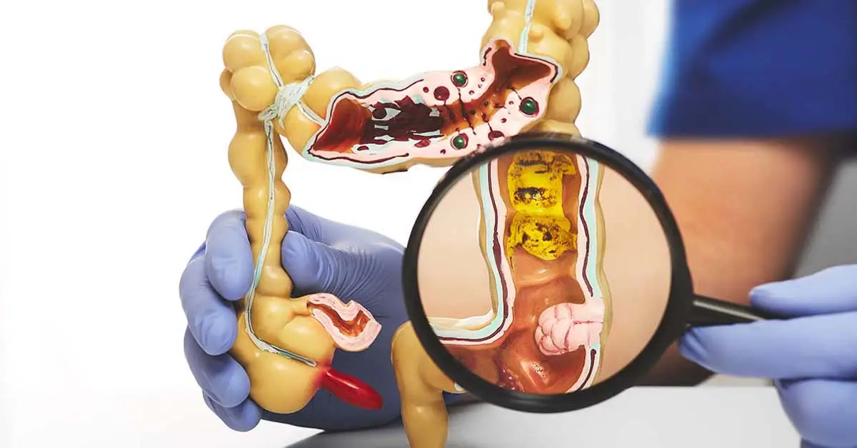 Common herb plant may be the key to cure colorectal cancer