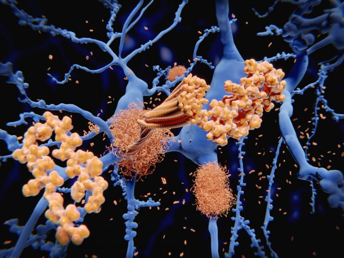 Washington University study reveals a common sleeping pill could reduce the buildup of Alzheimer's proteins 2 AmyloidBeta